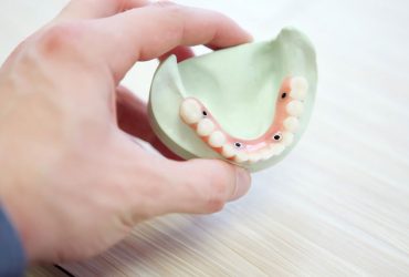 Occlusal Splints & Mouthguards